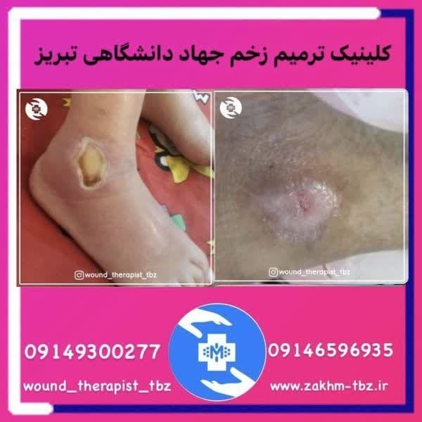 درمانگر زخم در تبریز