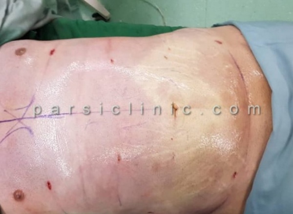 جراحی ابدومینوپلاستی