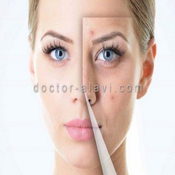 برداشتن خال و ضایعات پوستی
